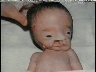 Depleted Uranium - radiation deformed Iraqi baby